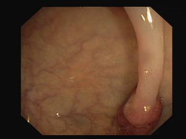 Sample image from CVC-ClinicDB