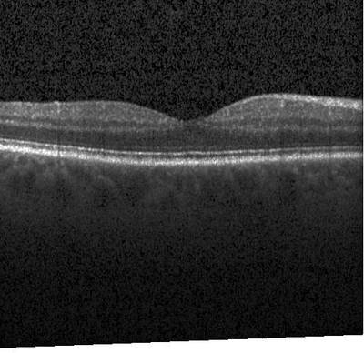 Sample image from ZhangLabData: OCT