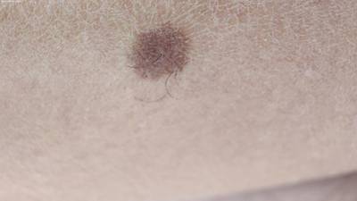 Sample image from Accurate Nevus Shapes