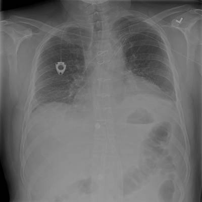 Sample image from SIIM-ACR Pneumothorax Segmentation 2019