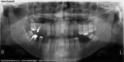 Sample image from Teeth Segmentation on Dental X-ray Images