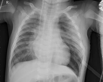 Sample image from ZhangLabData: Chest X-Ray