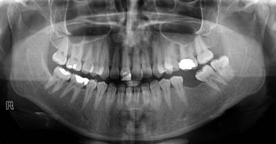Sample image from Panoramic Dental X-rays