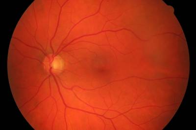 Sample image from High Resolution Fundus