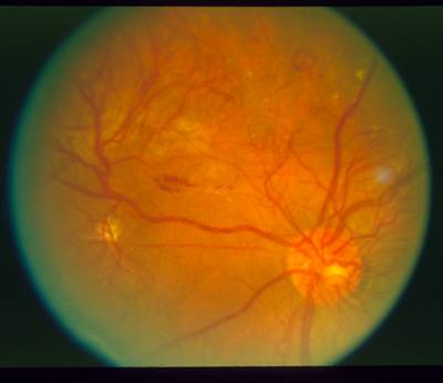 Sample image from STARE