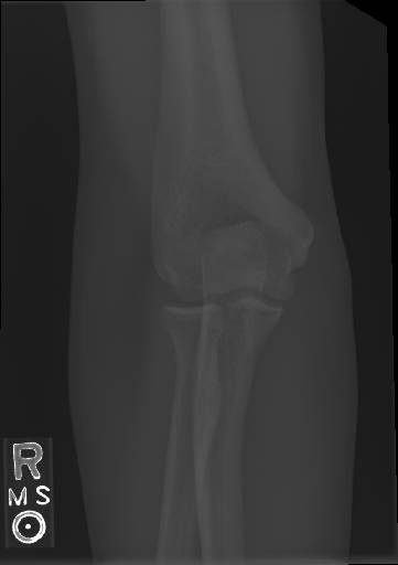 Sample image from Bone Classification and Detection Dataset