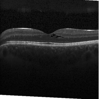 Sample image from Intraretinal Cystoid Fluid