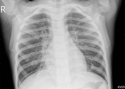 Sample image from ZhangLabData: Chest X-Ray
