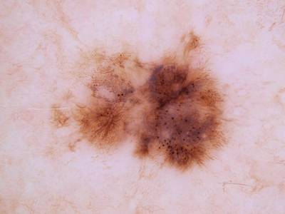 Sample image from Skin Cancer: HAM10000