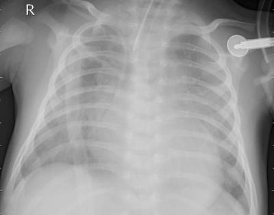 Sample image from ZhangLabData: Chest X-Ray