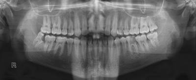 Sample image from Panoramic Dental X-rays