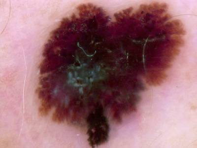 Sample image from Skin Cancer: HAM10000