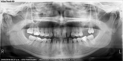Sample image from Teeth Segmentation on Dental X-ray Images