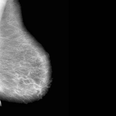 Sample image from CBIS-DDSM