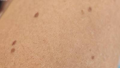Sample image from Accurate Nevus Shapes