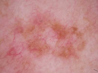 Sample image from Skin Cancer: HAM10000