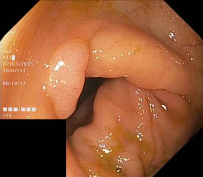 Sample image from HyperKvasir Images