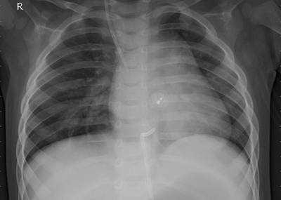 Sample image from ZhangLabData: Chest X-Ray