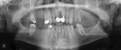 Sample image from Panoramic Dental X-rays