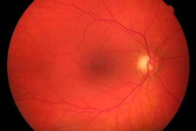 Sample image from High Resolution Fundus