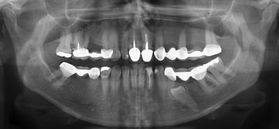 Sample image from Panoramic Dental X-rays