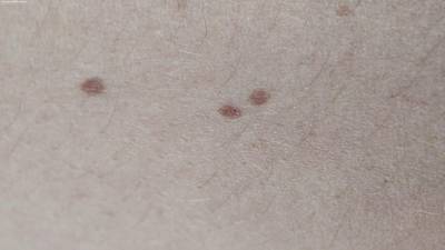 Sample image from Accurate Nevus Shapes