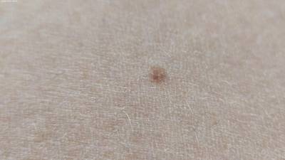 Sample image from Accurate Nevus Shapes