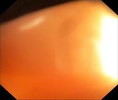 Sample image from PolypGen