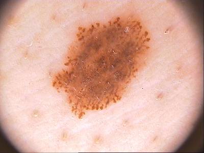 Sample image from ISIC 2017: Part 1 - Lesion Segmentation