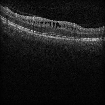 Sample image from Intraretinal Cystoid Fluid
