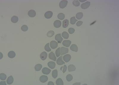Sample image from P. Vivax (Malaria) Infected Human Blood Smears