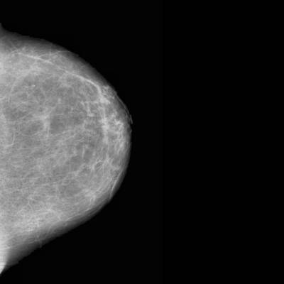 Sample image from CBIS-DDSM