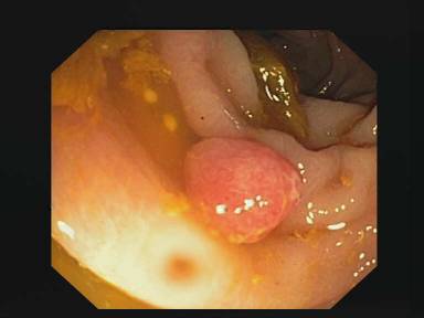 Sample image from CVC-ClinicDB