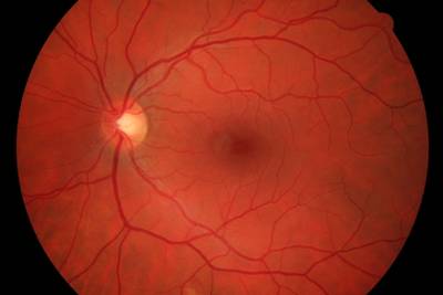 Sample image from High Resolution Fundus