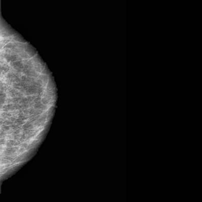 Sample image from CBIS-DDSM