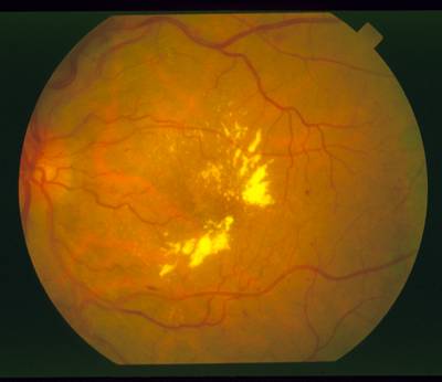 Sample image from STARE