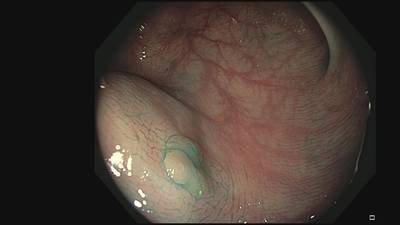 Sample image from Fine Grained Polyp