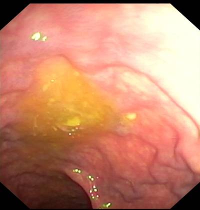 Sample image from PolypGen