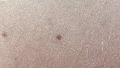Sample image from Accurate Nevus Shapes