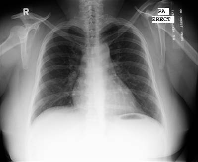 Sample image from Chest Xray Masks and Labels
