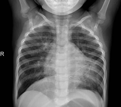 Sample image from ZhangLabData: Chest X-Ray