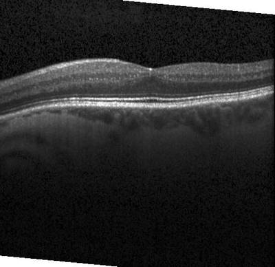 Sample image from ZhangLabData: OCT