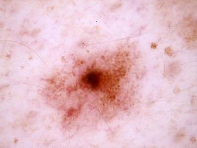 Sample image from Skin Cancer: HAM10000