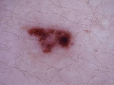 Sample image from Skin Cancer: HAM10000