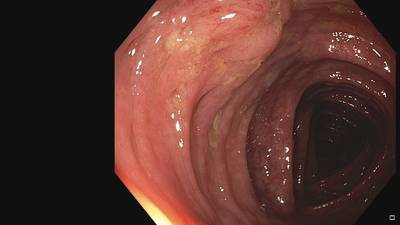 Sample image from Fine Grained Polyp