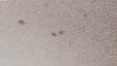 Sample image from Accurate Nevus Shapes