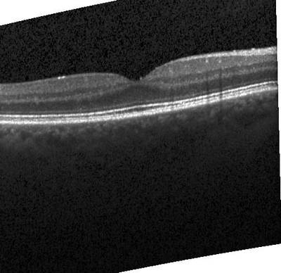 Sample image from ZhangLabData: OCT
