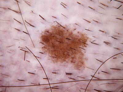 Sample image from Skin Cancer: HAM10000