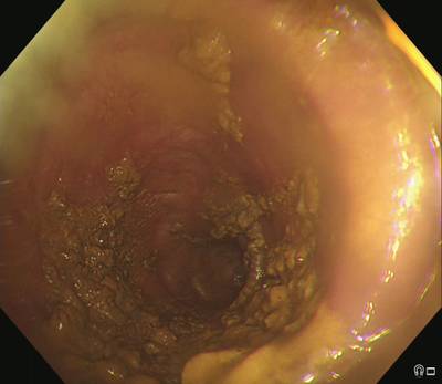 Sample image from PolypGen