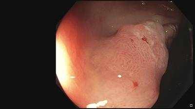 Sample image from Fine Grained Polyp